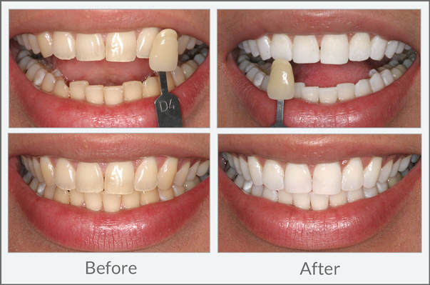 whitening before and after